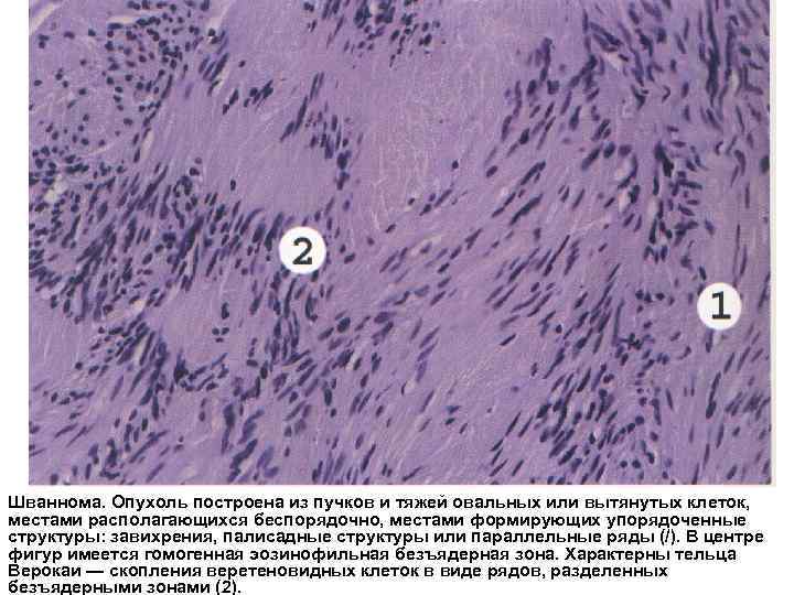 Шваннома. Опухоль построена из пучков и тяжей овальных или вытянутых клеток, местами располагающихся беспорядочно,