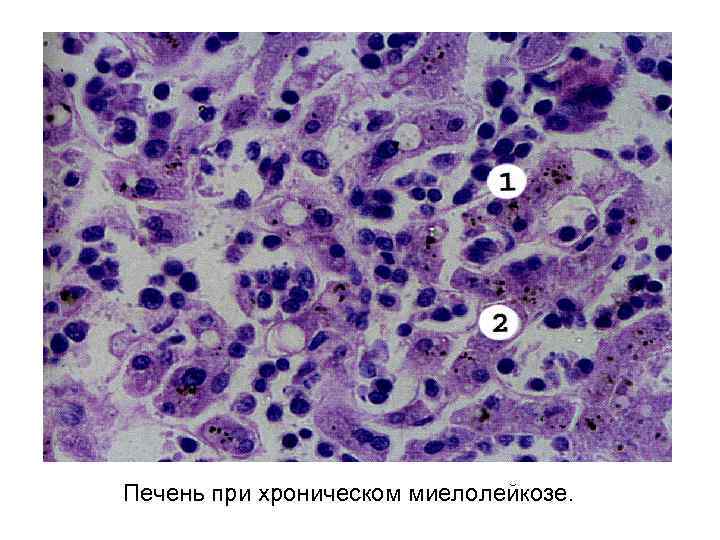 Печень при хроническом миелолейкозе. 