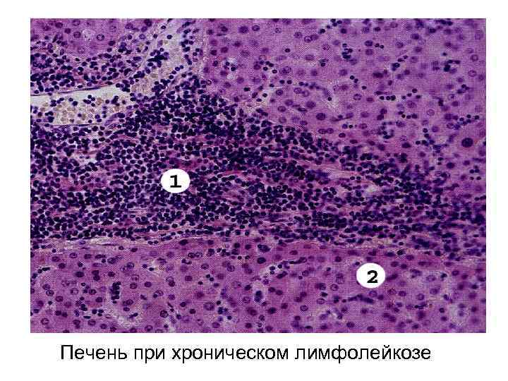 Печень при хроническом лимфолейкозе 