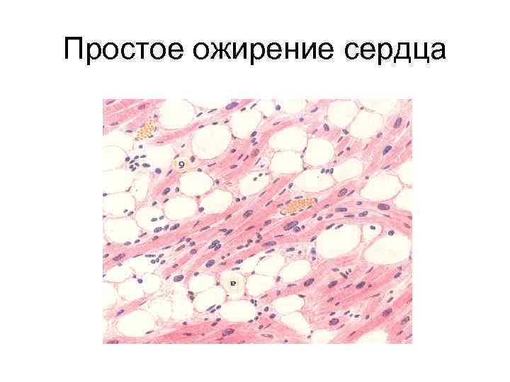 Простое ожирение сердца 