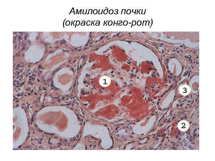 Амилоидоз почки (окраска конго-рот) 