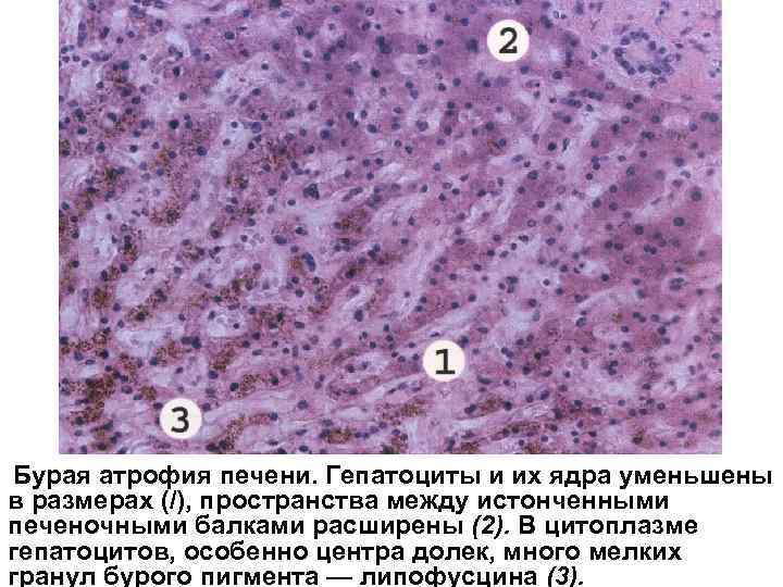 Бурая атрофия печени. Гепатоциты и их ядра уменьшены в размерах (/), пространства между истонченными