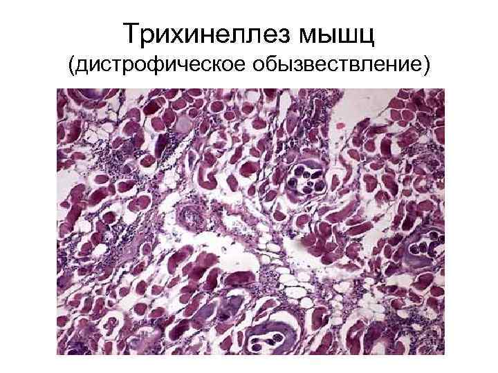 Трихинеллез мышц (дистрофическое обызвествление) 
