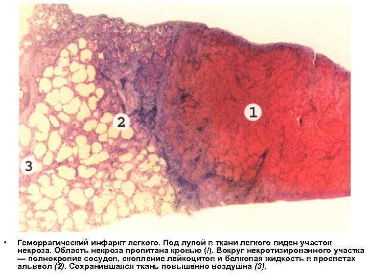  • Геморрагический инфаркт легкого. Под лупой в ткани легкого виден участок некроза. Область