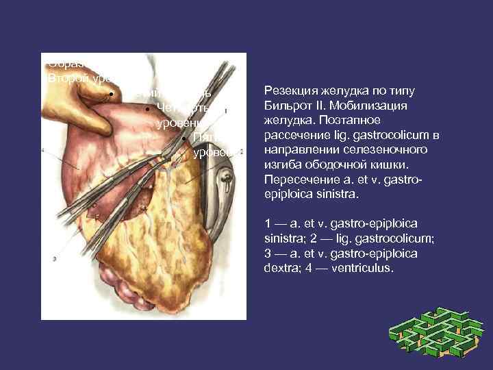 Образец текста Второй уровень Третий уровень Четвертый уровень Пятый уровень Резекция желудка по типу