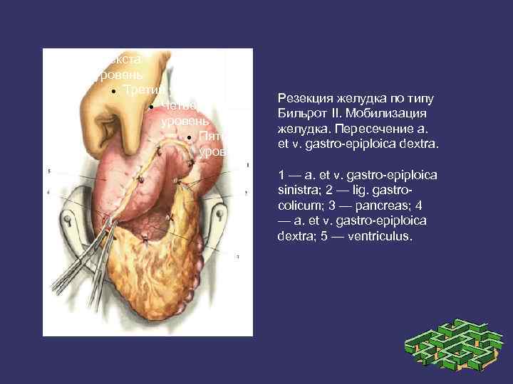 Образец текста Второй уровень Третий уровень Четвертый уровень Пятый уровень Резекция желудка по типу