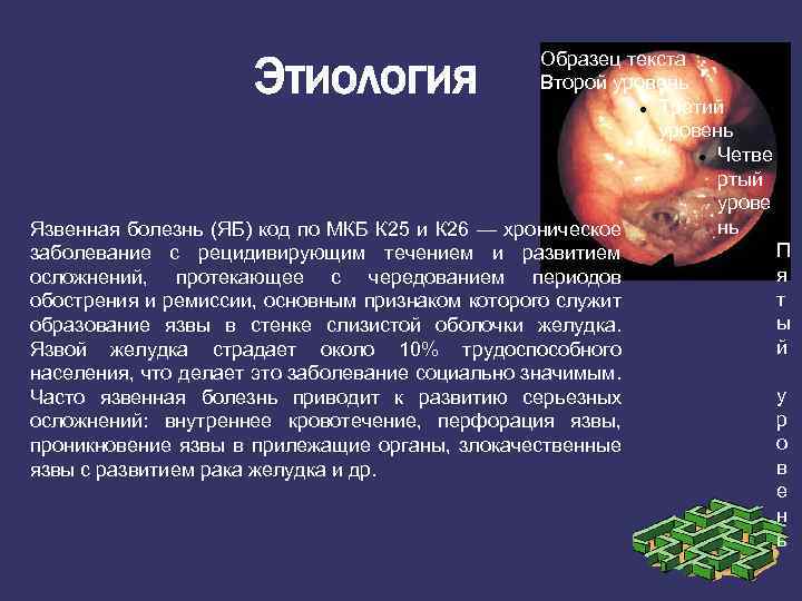 Этиология Образец текста Второй уровень Третий уровень Четве ртый урове нь Язвенная болезнь (ЯБ)