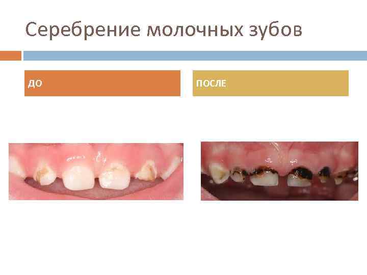 Серебрение молочных зубов ДО ПОСЛЕ 