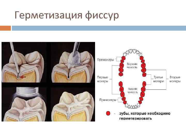 Герметизация фиссур 