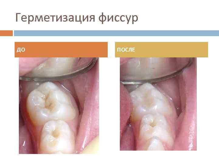 Герметизация фиссур ДО ПОСЛЕ 