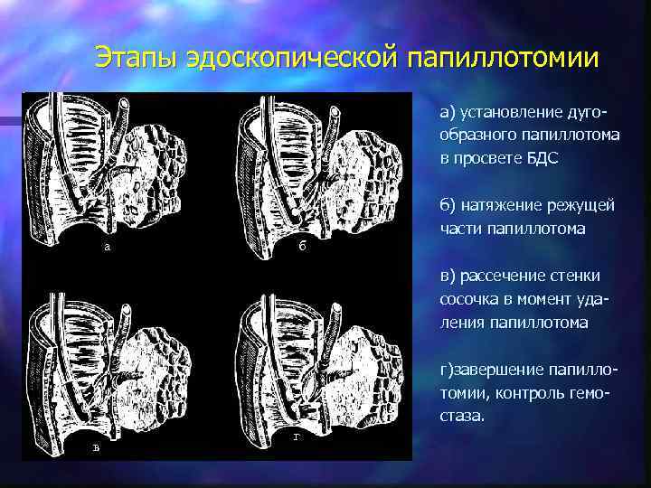 Этапы эдоскопической папиллотомии а) установление дугообразного папиллотома в просвете БДС а б б) натяжение