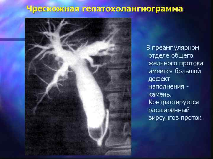 Чрескожная гепатохолангиограмма В преампулярном отделе общего желчного протока имеется большой дефект наполнения камень. Контрастируется