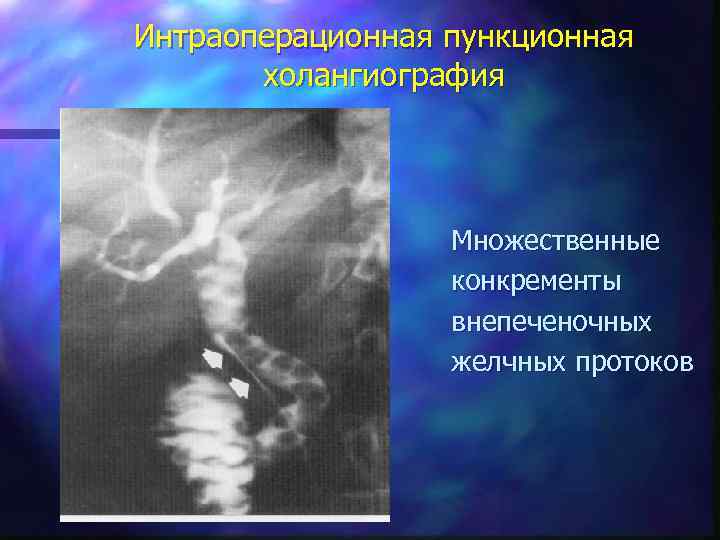 Интраоперационная пункционная холангиография Множественные конкременты внепеченочных желчных протоков 