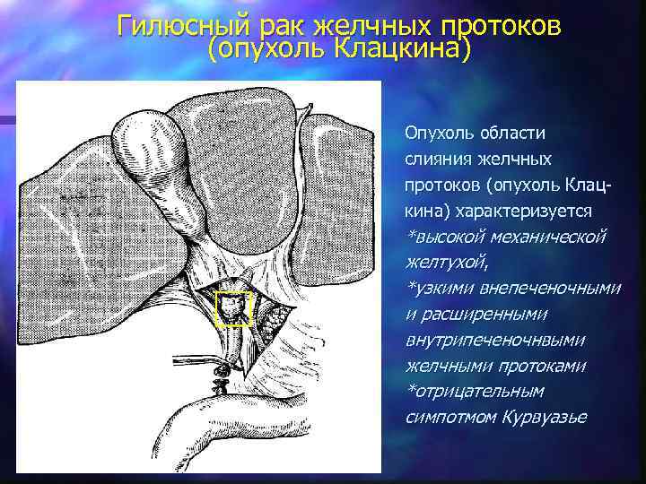 Гилюсный рак желчных протоков (опухоль Клацкина) Опухоль области слияния желчных протоков (опухоль Клацкина) характеризуется