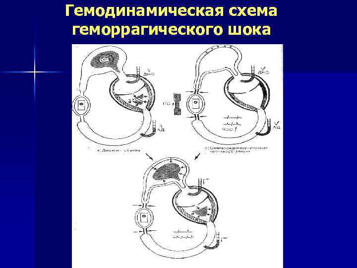 Гемодинамическая схема геморрагического шока 