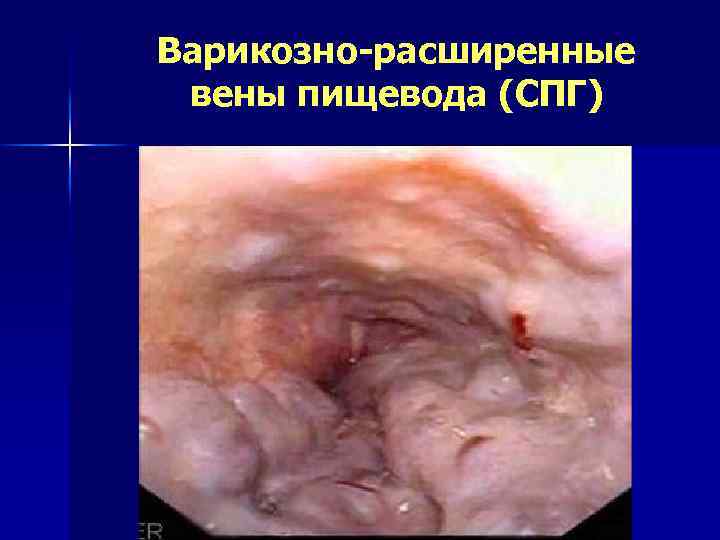 Варикозно-расширенные вены пищевода (СПГ) 