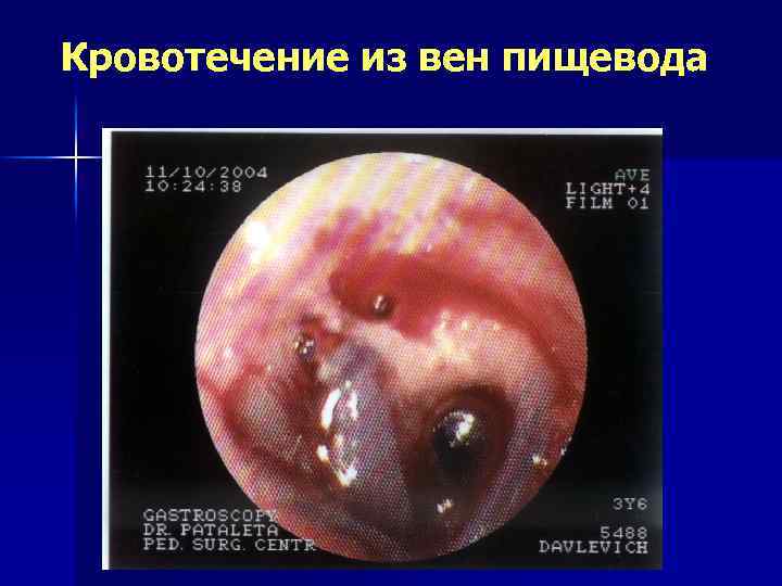 Кровотечение из вен пищевода 