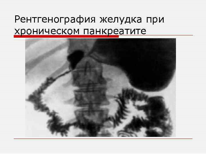 Рентгенография желудка при хроническом панкреатите 