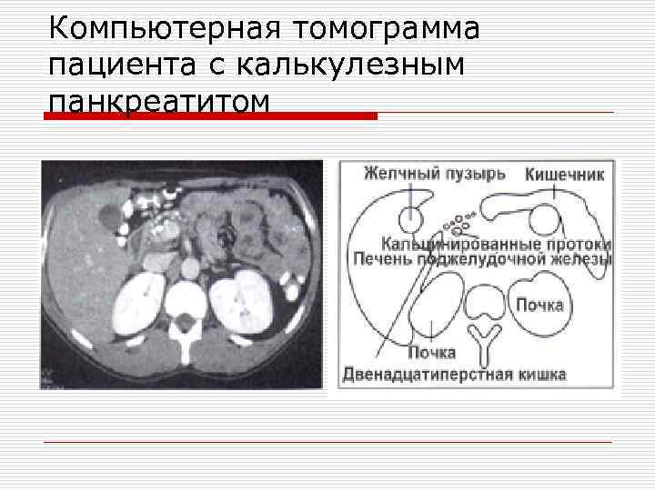 Компьютерная томограмма пациента с калькулезным панкреатитом 