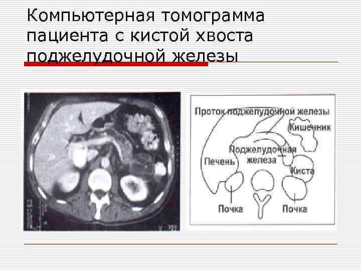 Компьютерная томограмма пациента с кистой хвоста поджелудочной железы 