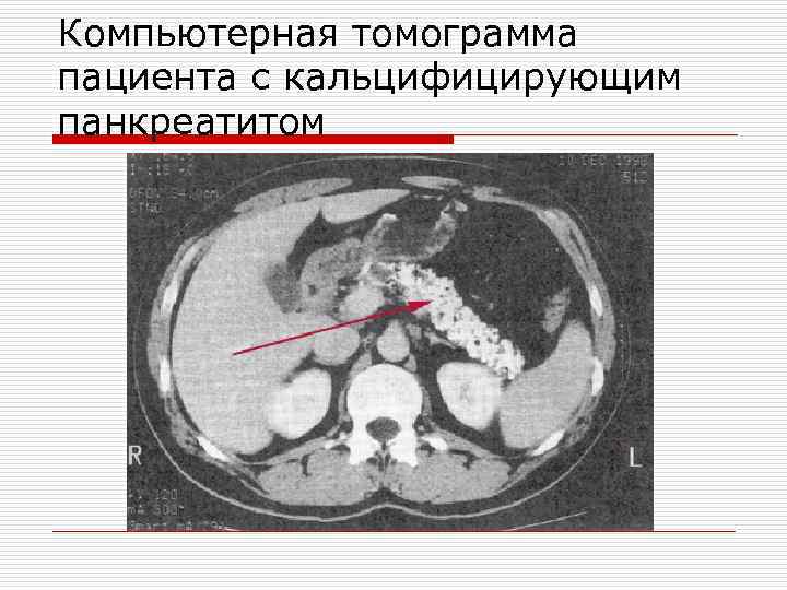Компьютерная томограмма пациента с кальцифицирующим панкреатитом 