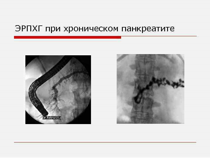 ЭРПХГ при хроническом панкреатите 