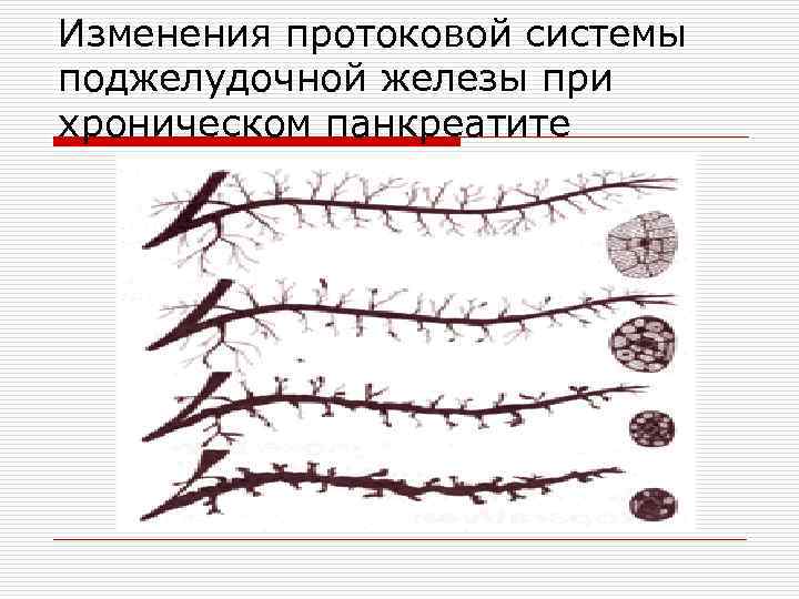 Изменения протоковой системы поджелудочной железы при хроническом панкреатите 