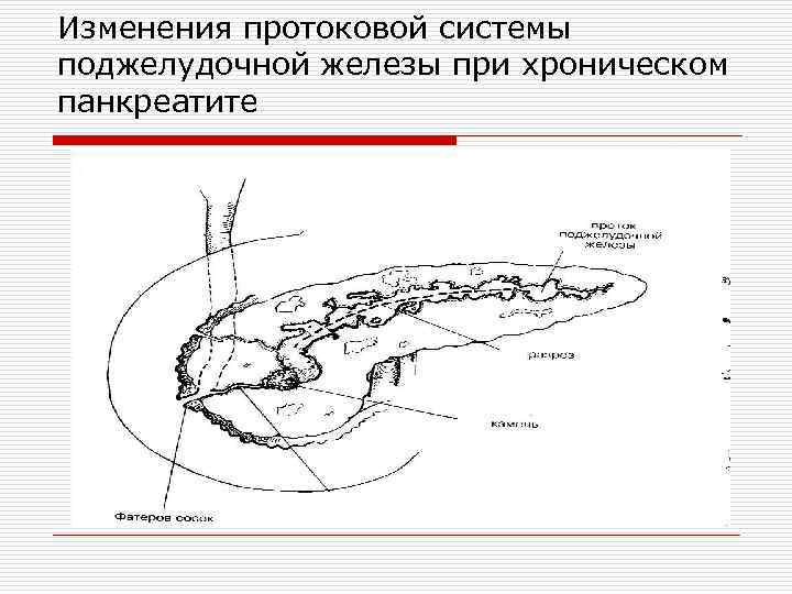 Изменения протоковой системы поджелудочной железы при хроническом панкреатите 