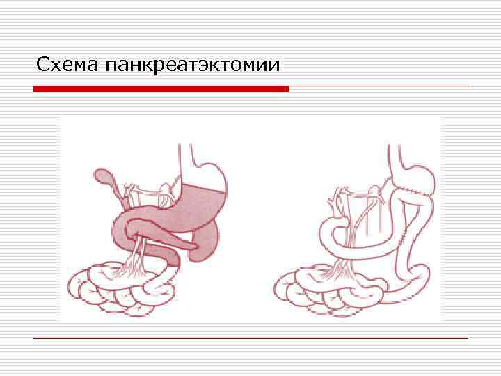Схема панкреатэктомии 