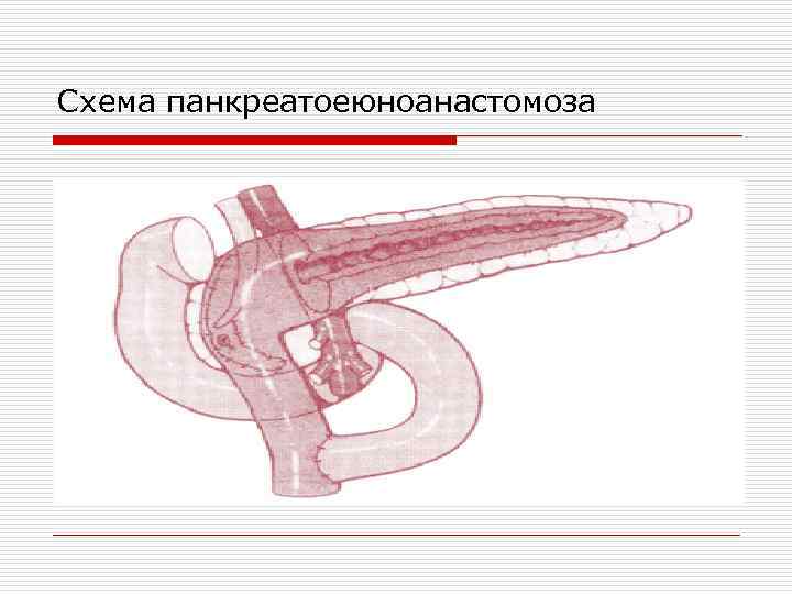 Схема панкреатоеюноанастомоза 