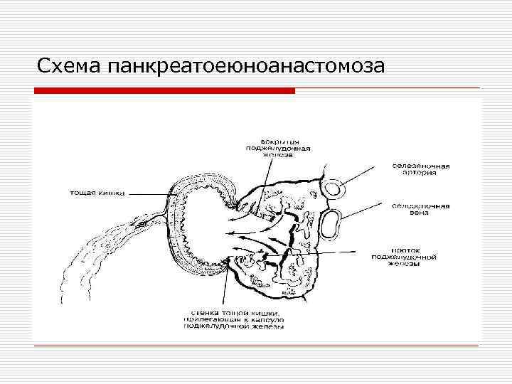 Схема панкреатоеюноанастомоза 