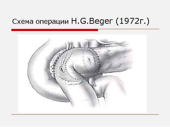 Схема операции H. G. Beger (1972 г. ) 