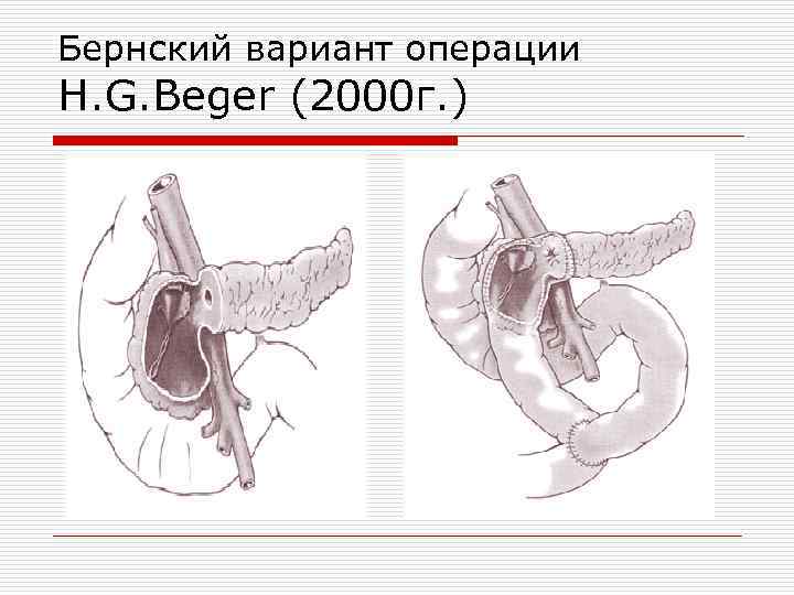 Операция фрея на поджелудочной железе схема