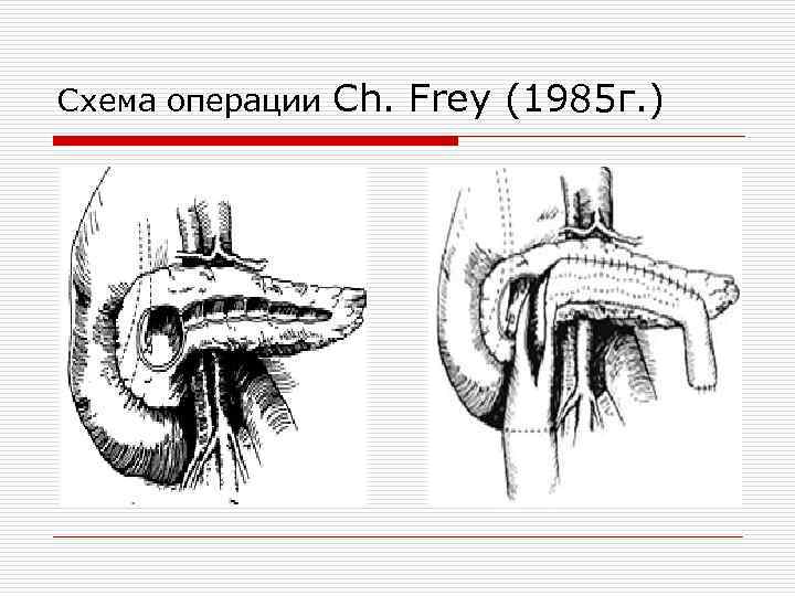 Схема операции Ch. Frey (1985 г. ) 