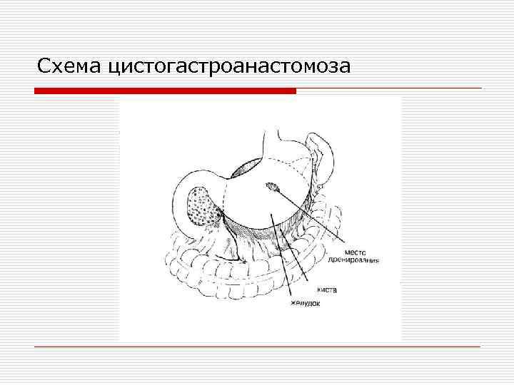 Схема цистогастроанастомоза 