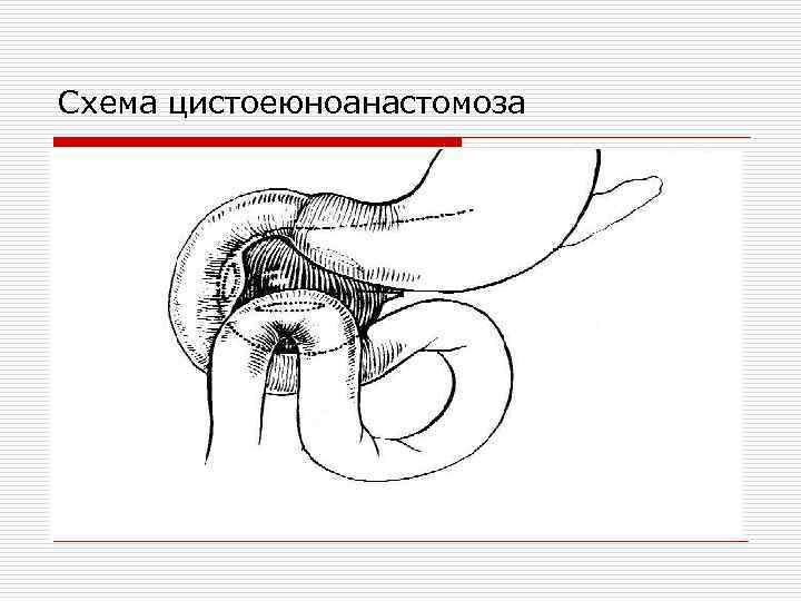 Схема цистоеюноанастомоза 
