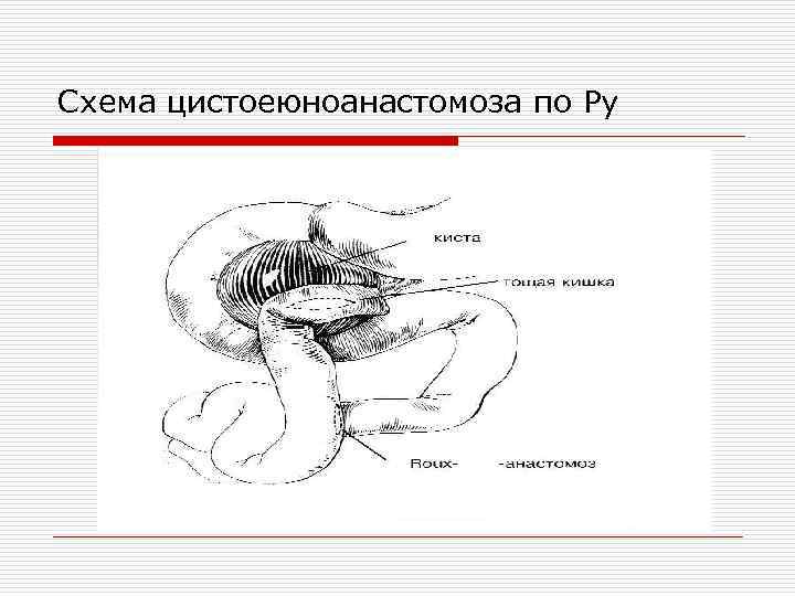 Анастомоз по ру схема