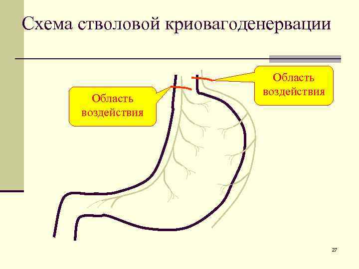Схема стволовой криовагоденервации Область воздействия 27 