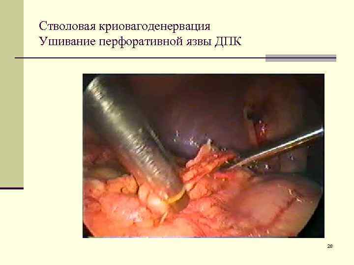 Стволовая криовагоденервация Ушивание перфоративной язвы ДПК 28 