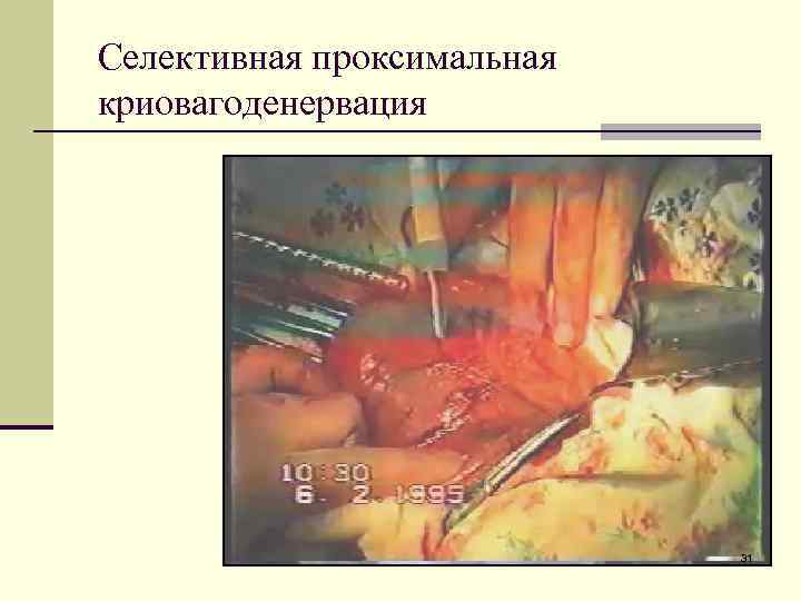 Селективная проксимальная криовагоденервация 31 