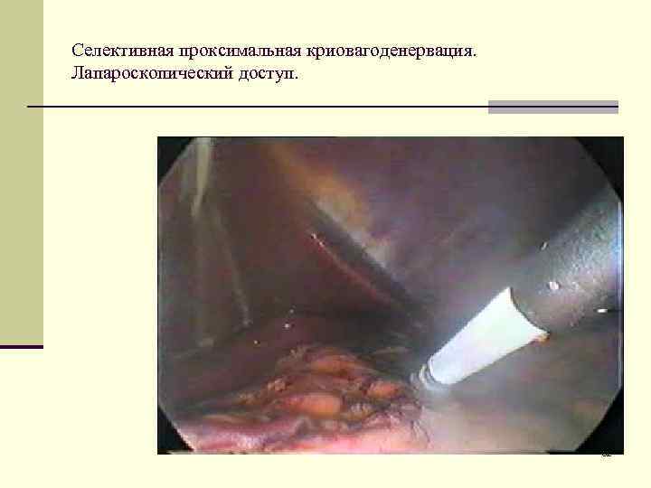 Селективная проксимальная криовагоденервация. Лапароскопический доступ. 32 
