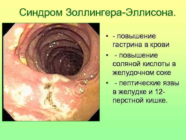 Синдром Золлингера-Эллисона. • - повышение гастрина в крови • - повышение соляной кислоты в