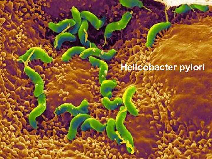 Helicobacter pylori 