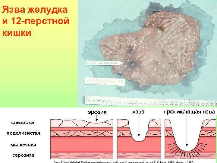 Язва желудка и 12 -перстной кишки эрозия слизистая подслизистая мышечная серозная язва проникающая язва