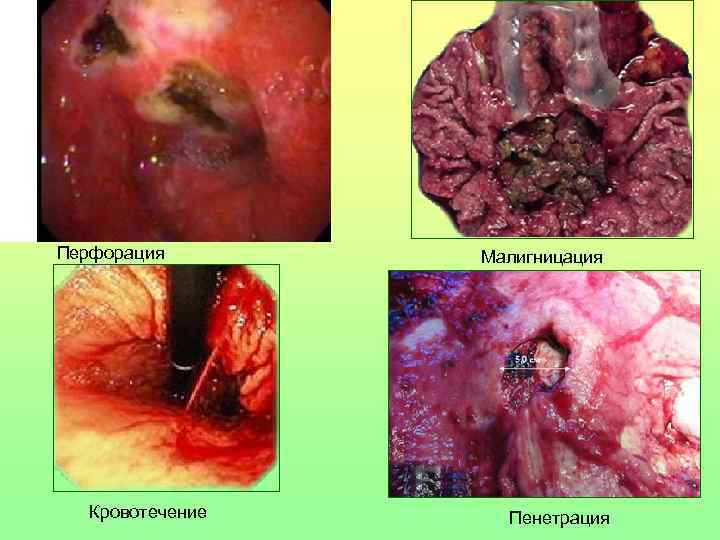 Перфорация Кровотечение Малигницация Пенетрация 