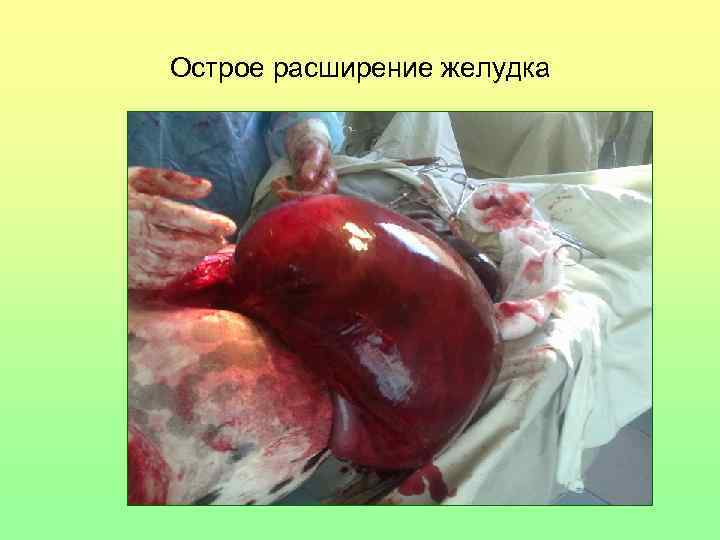 Острое расширение желудка 