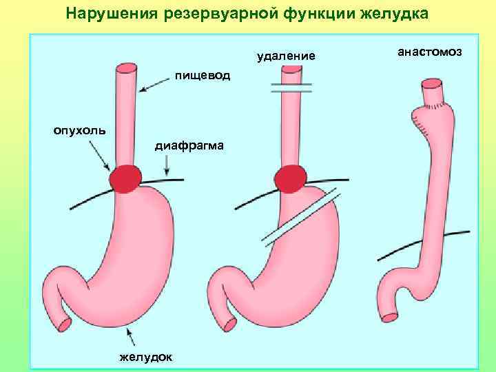 Нарушения резервуарной функции желудка удаление пищевод опухоль диафрагма желудок анастомоз 