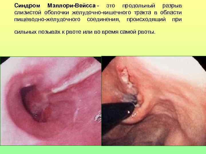 Синдром Мэллори-Вейсса - это продольный разрыв слизистой оболочки желудочно-кишечного тракта в области пищеводно-желудочного соединения,