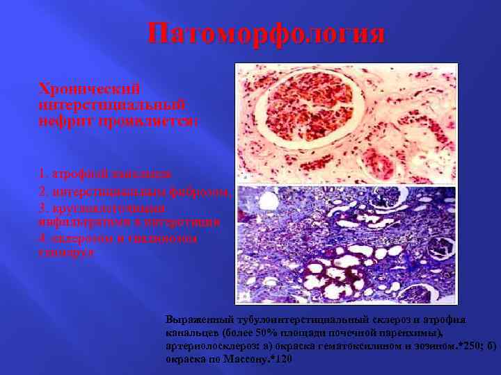 Патоморфология Хронический интерстициальный нефрит проявляется: 1. атрофией канальцев 2. интерстициальным фиброзом, 3. круглоклеточными инфильтратами