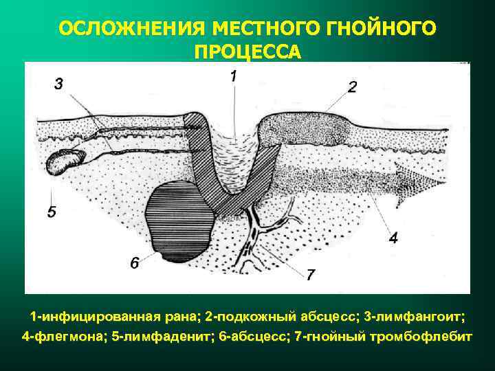 ОСЛОЖНЕНИЯ МЕСТНОГО ГНОЙНОГО ПРОЦЕССА 1 -инфицированная рана; 2 -подкожный абсцесс; 3 -лимфангоит; 4 -флегмона;